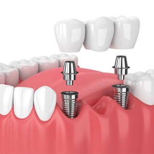 Render of two dental implants in Newton, MA supporting a bridge