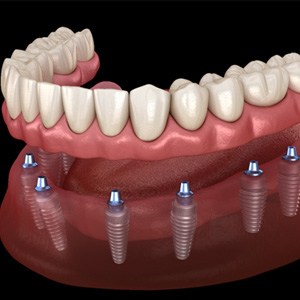 Render of dental implants in Newton, MA and full denture
