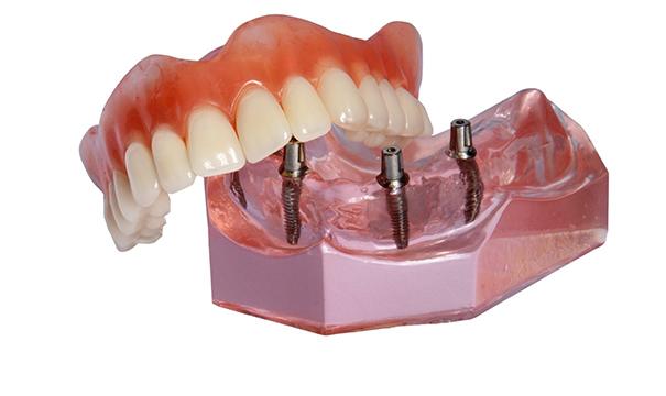 Implant-retained denture in Newton model 