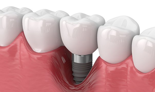 Illustration of bone loss around a dental implant in Newton, MA