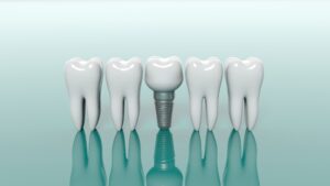 Dental implant and molars on light green background