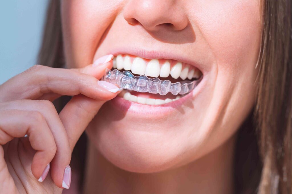 Woman putting in a clear aligner